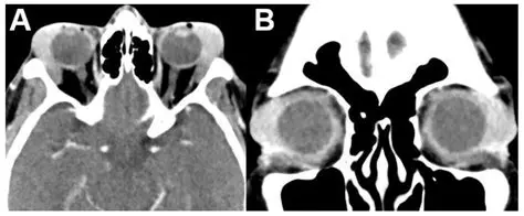 Understanding Orbital Tumors